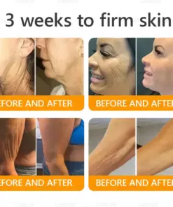 Daasry® Bee Venom Treatment Cream with bee venom peptides, botulinum toxin, hyaluronic acid, and collagen. Targets wrinkles, fine lines, sagging, stretch marks, dark spotsfirming, lifting and more